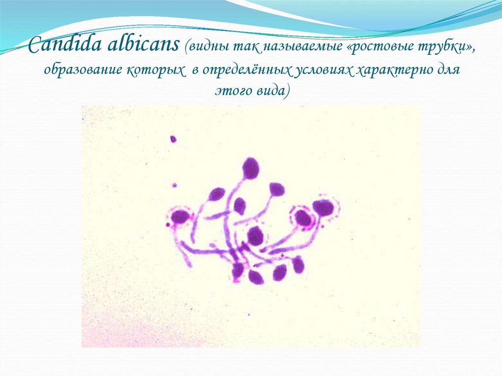 Опрелость, вызванная грибами рода Candida. Ростовая трубка бактерий.