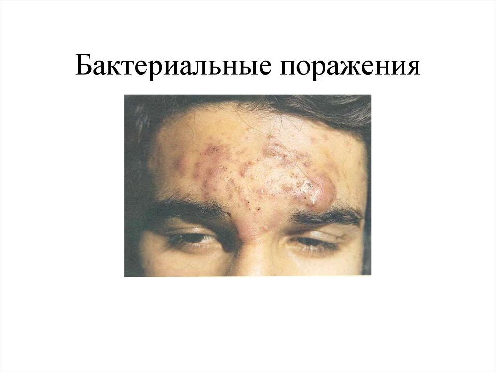 Бактериальные поражения