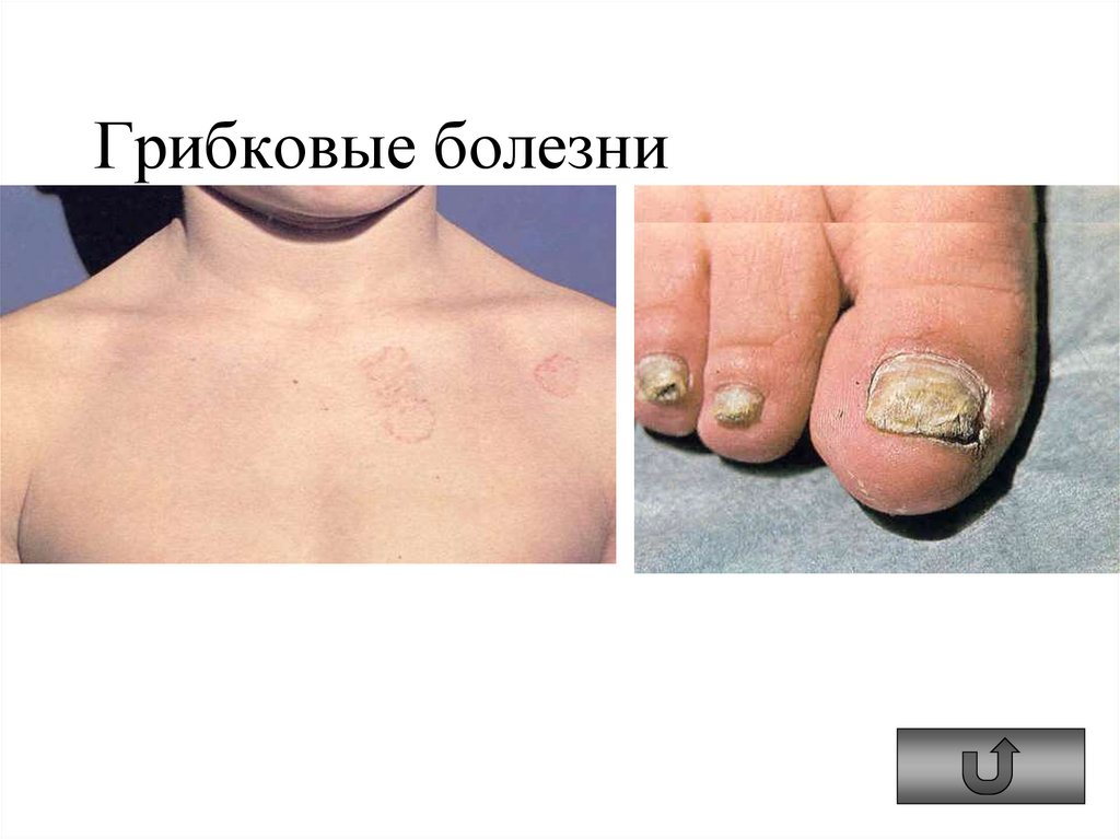 Грибковые болезни