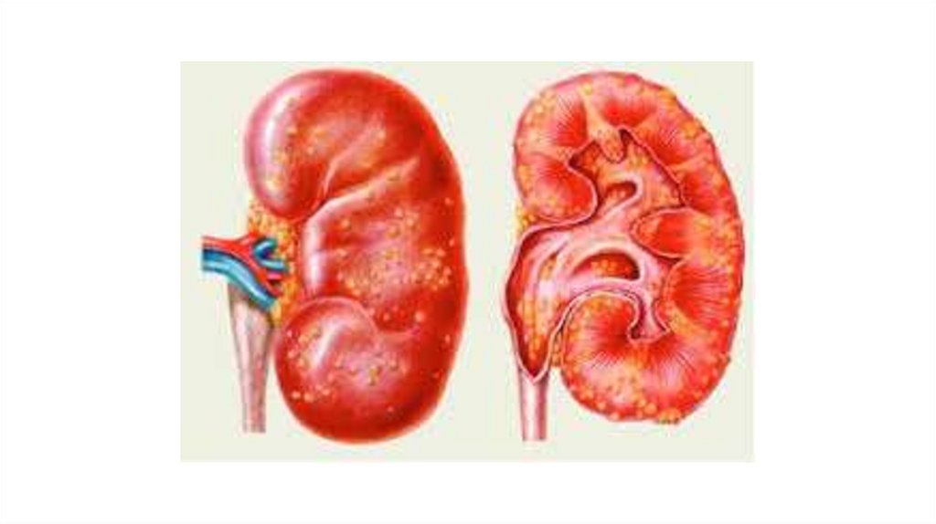 Больные почки. Апостематозный пиелонефрит. Нефрит ,пиелонефрит почек. Пиелонефрит воспаление почек заболевание. Апостематозный гломерулонефрит.