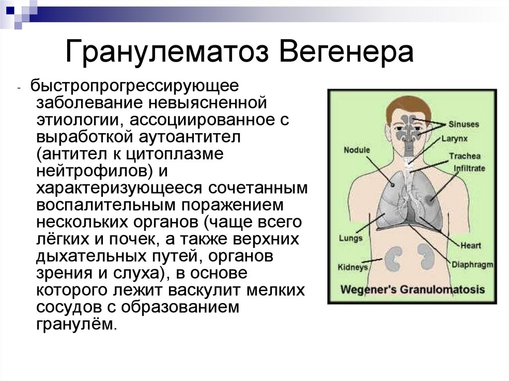 Гранулематоз Вегенера - презентация онлайн