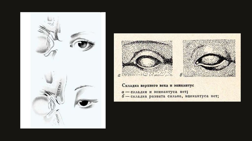 Эпикантус - презентация онлайн