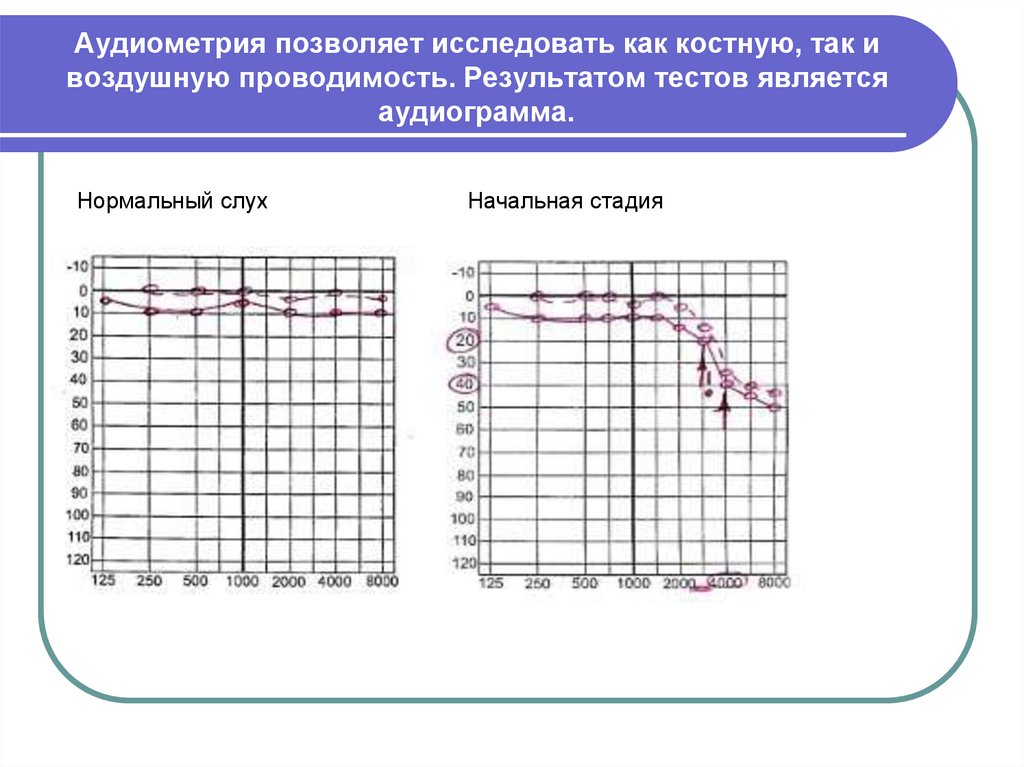 Графическое изображение на специальном бланке данных исследования состояния слуха проводимого с