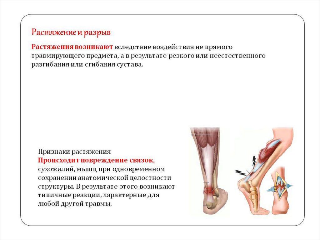 Причины разрыва мышц. Растяжение связок мышц сухожилий первая помощь. Симптомы растяжения и разрыва связок. Клинические проявления растяжения.