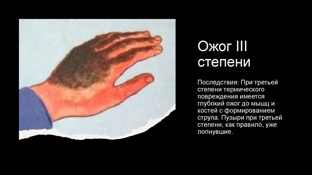 Характеристика ожогов - презентация онлайн