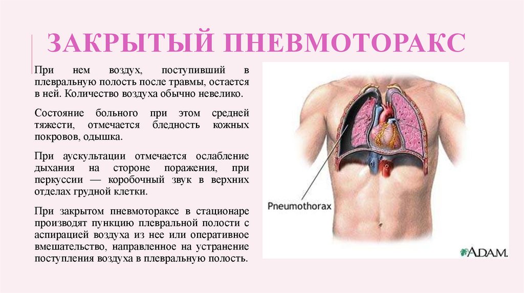 Ответы нмо закрытая травма грудной клетки 2021. Пневмоторакс смешная картинка.