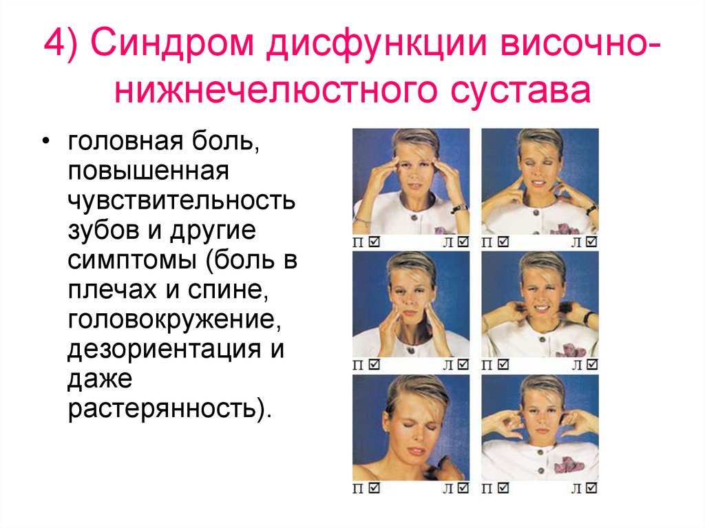 4) Синдром дисфункции височно-нижнечелюстного сустава