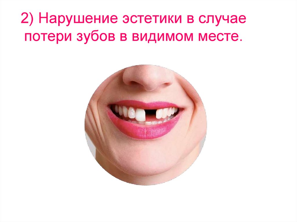 2) Нарушение эстетики в случае потери зубов в видимом месте.