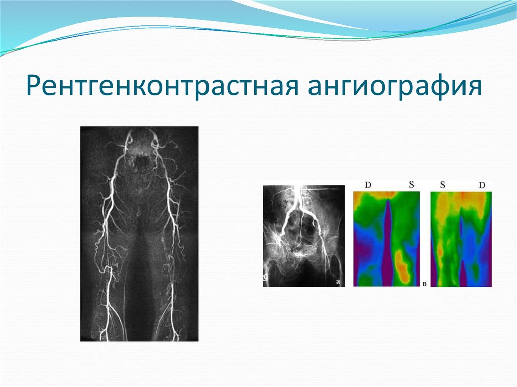 Флебография вен нижних. Атеросклероз нижних конечностей ангиография. Флебография вен нижних конечностей. Кт флебография нижних конечностей. Атеросклероз сосудов нижних конечностей кт.