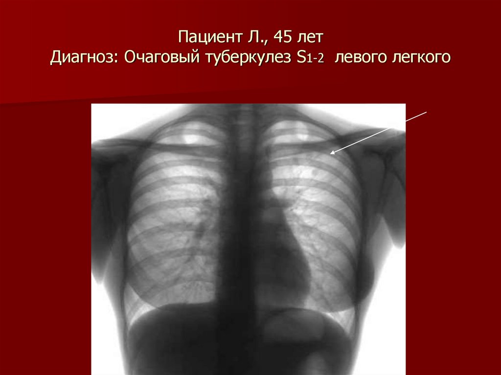 Очаговый туберкулез. Очаговый туберкулез s2 левого легкого. Очаговый туберкулез s1-s2 правого легкого в фазе инфильтрации. МБТ (+) .. Очаговый туберкулез 1-2 сегментов левого легкого. Очаговый туберкулез с2 правого легкого.