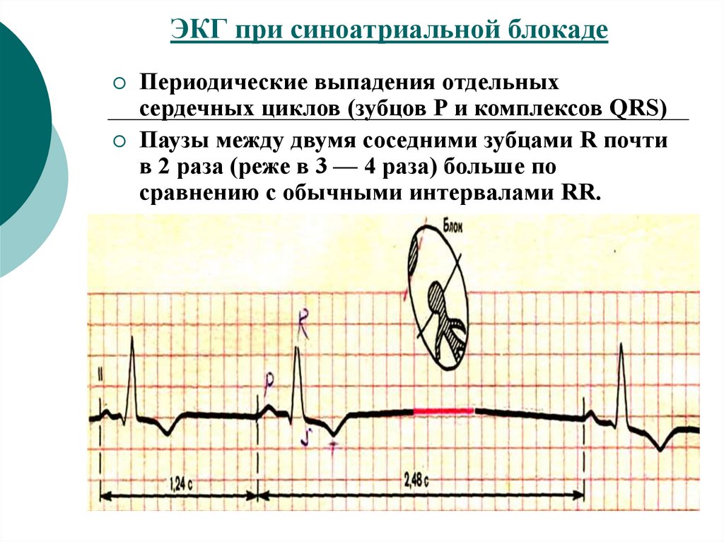 Признаки синоатриальной блокады. Синоатриальная блокада на ЭКГ. Синоатриальная блокада клинические рекомендации. Электрокардиографические заключение при синоатриальной блокаде. При полной синоатриальной блокаде регистрируется.