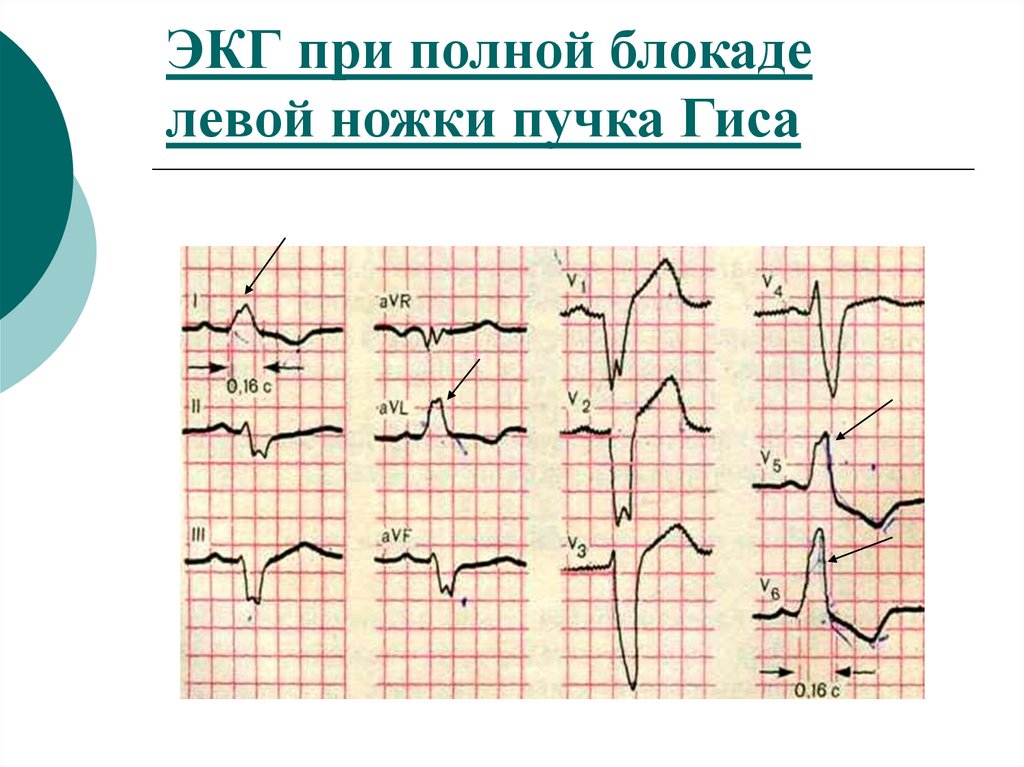 Признаки блокада левой ножки. ЭКГ при блокаде левой ножки пучка Гиса. Ножки пучка Гиса. Ножки пучка Гиса вживую фото.