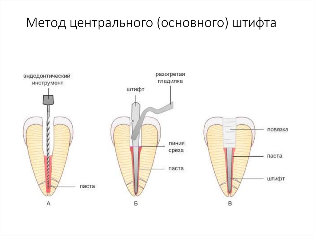 Методы обтурации корневых каналов презентация