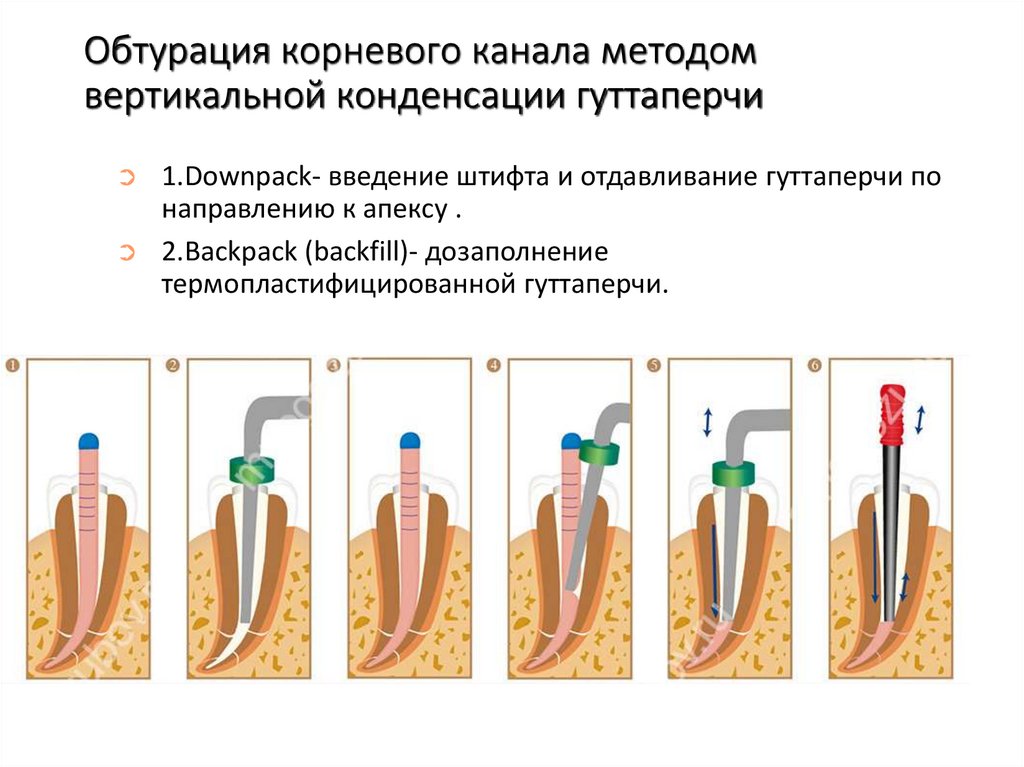 Пломбирование гуттаперчей латеральная