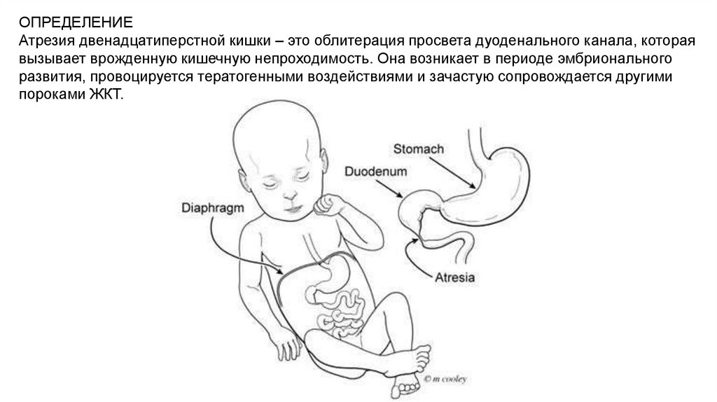 Атрезия ДПК - online presentation