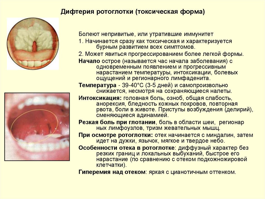 Диагностика дифтерии ротоглотки