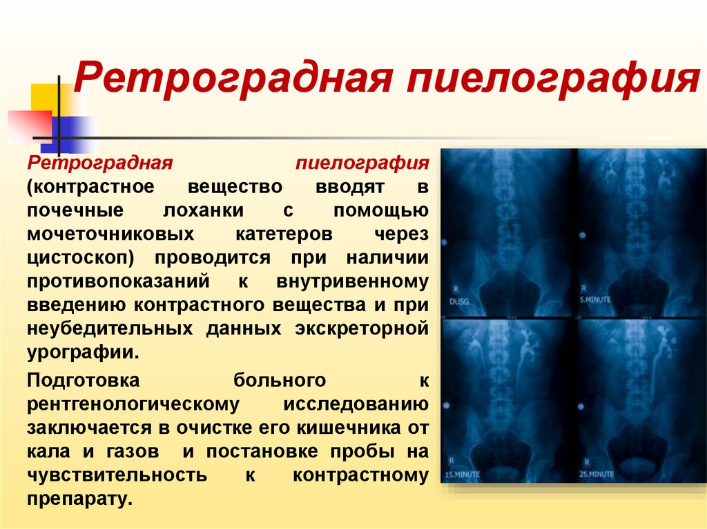 После контраста. Ретроградная урография рентген. Ретроградная пиелография. Экскреторная и ретроградная урография. Пиелография контрастное вещество.