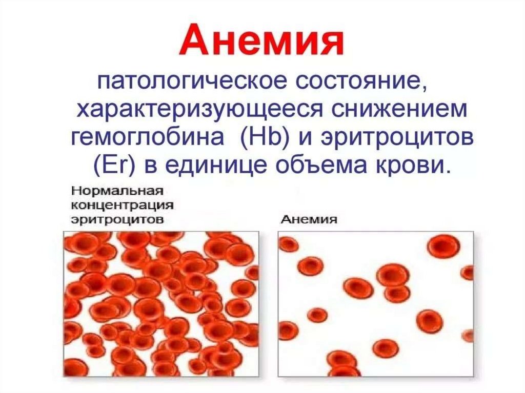 В крови сильно повышен. Заболевание крови анемия. Эритроциты в крови анемия. Железодефицитная анемия эритроциты.