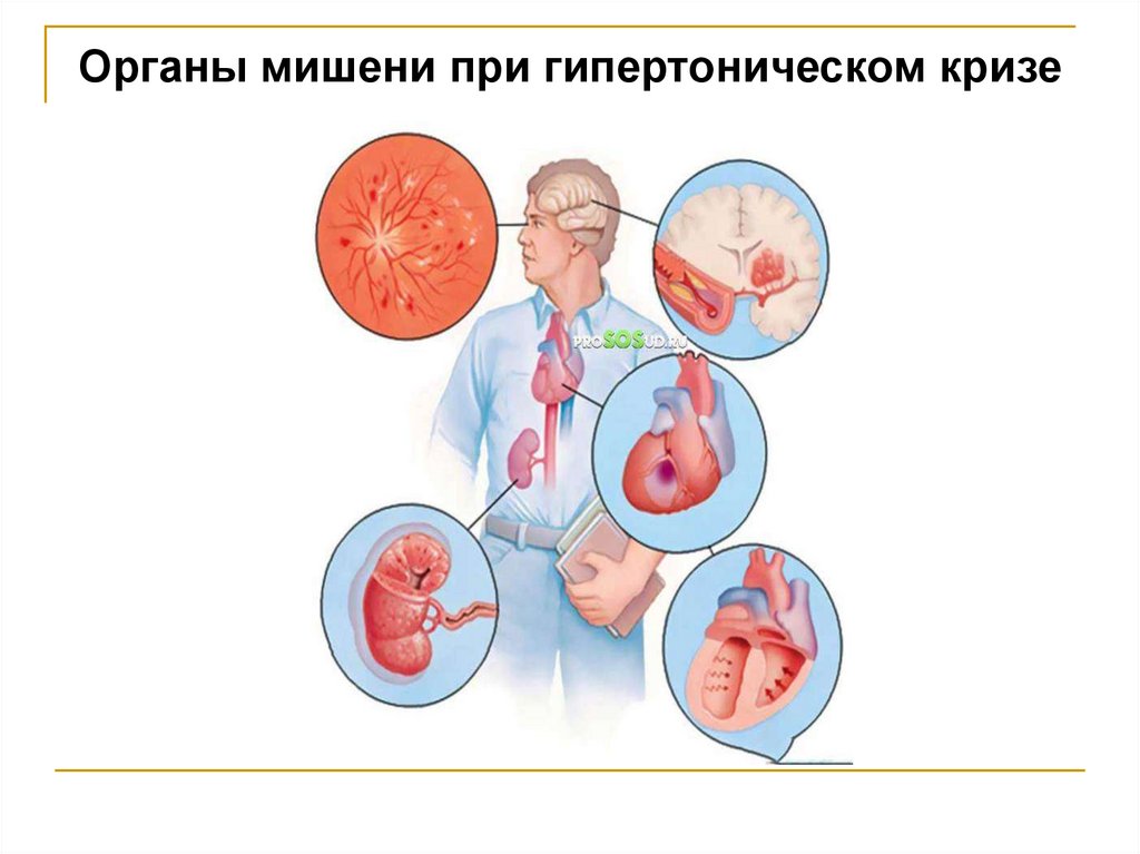 Гипертонический криз картинки для презентации