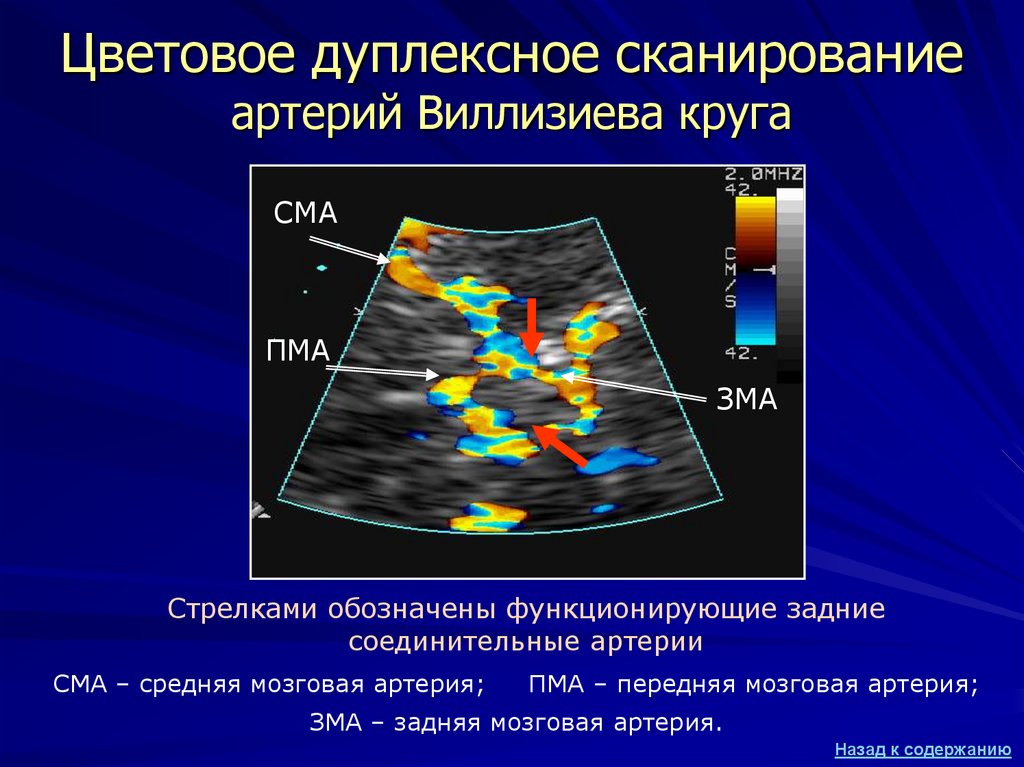 Доплер артерий. Ультразвуковое цветовое дуплексное сканирование. УЗДГ – ультразвуковая допплерография сосудов. Дуплексное сканирование сосудов брахиоцефальной зоны. Ультразвуковое дуплексное ангиосканирование.