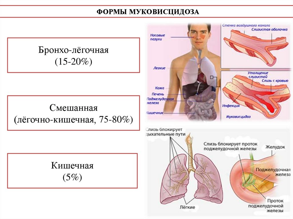 Муковисцидоз - презентация онлайн