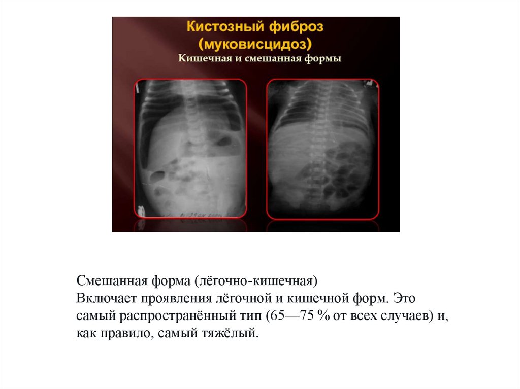 Муковисцидоз - презентация онлайн