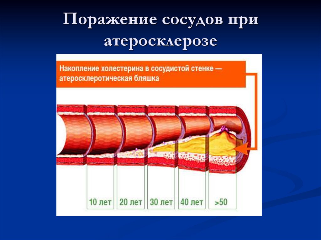 2 стадия атеросклероза