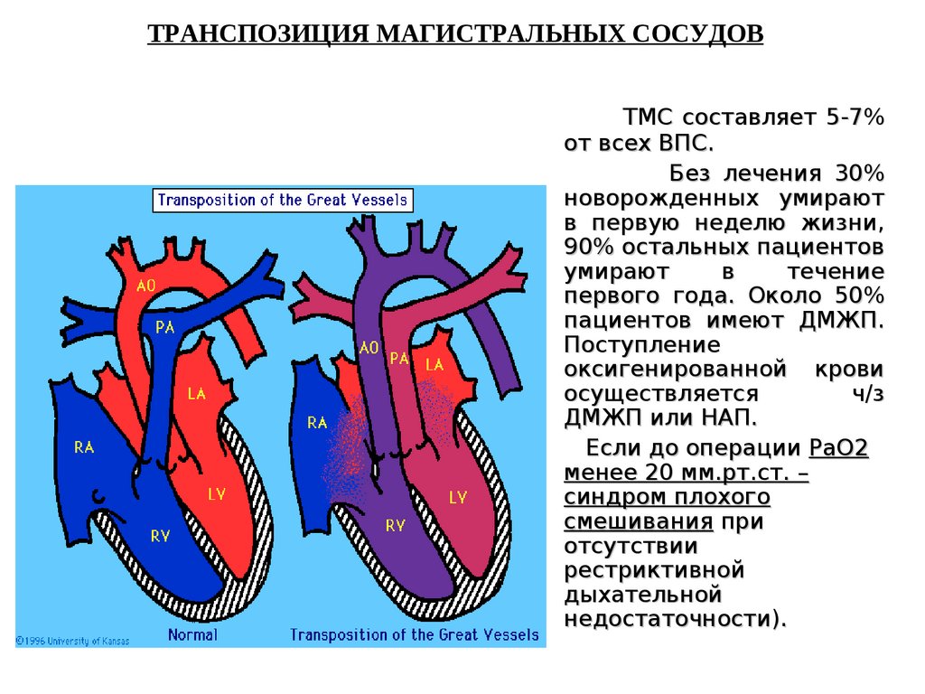 Транспозиция артерии