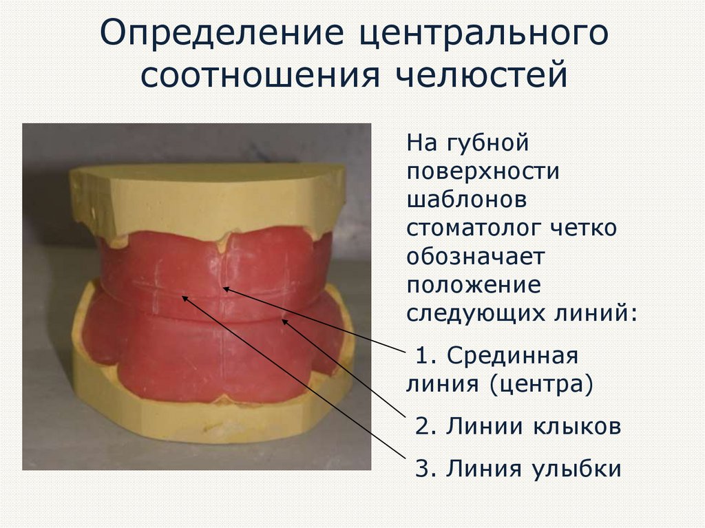 Определение центрального соотношения челюстей презентация