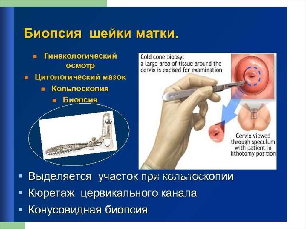 Биопсия шейки матки. Взятие биопсии шейки матки. Биопсия. Показания, инструментарий.