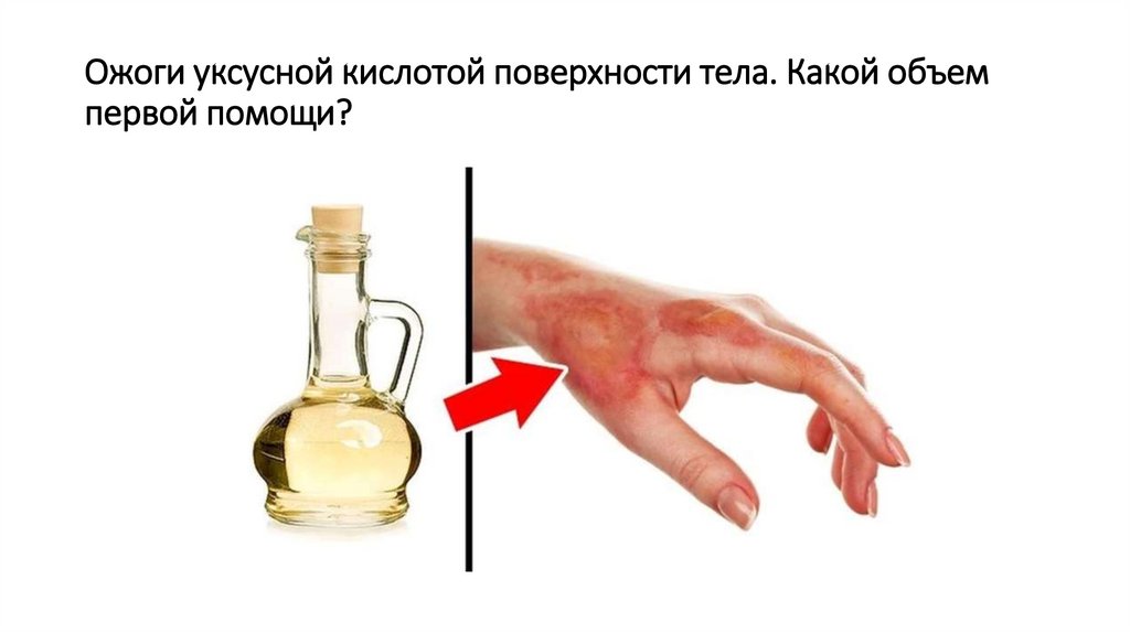 Какой объем первой помощи при химическом ожоге хлоркой? - презентация ...