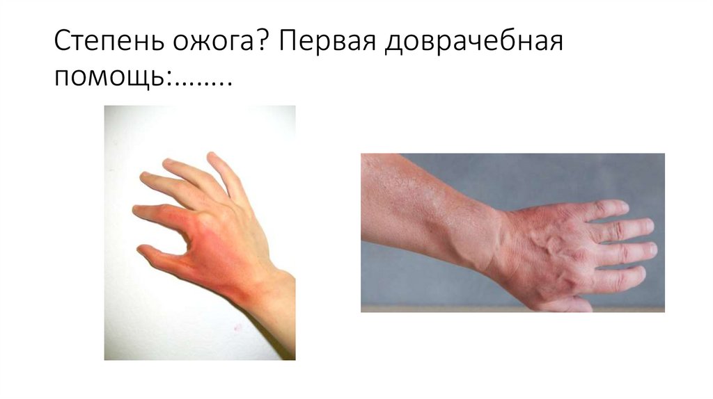 Какой объем первой помощи при химическом ожоге хлоркой? - презентация ...