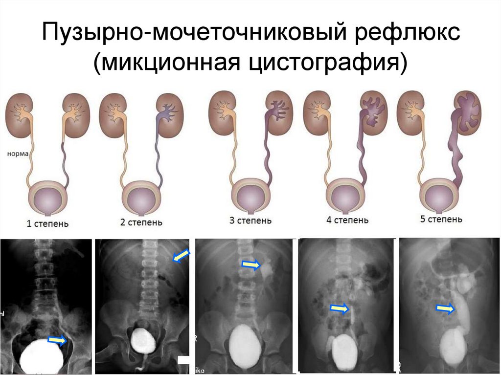 Рефлюкс нефропатия презентация