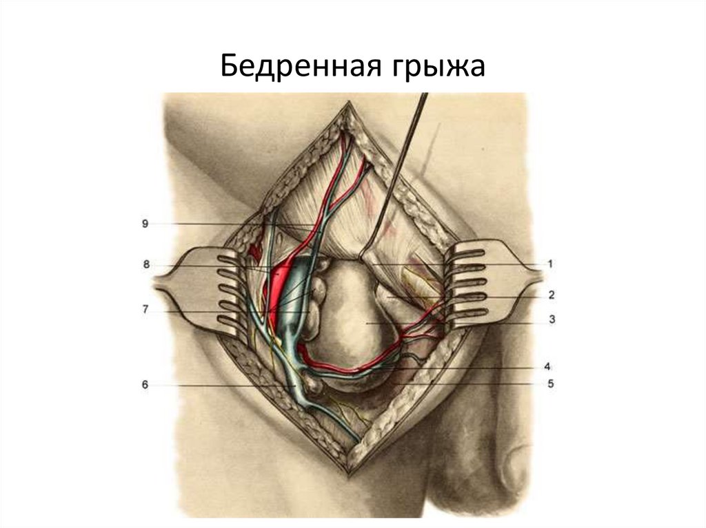 Бедренная грыжа. Бедренные грыжи топографическая анатомия. Топография типичной бедренной грыжи. Топографическая анатомия паховой грыжи. Паховая грыжа топографическая анатомия.