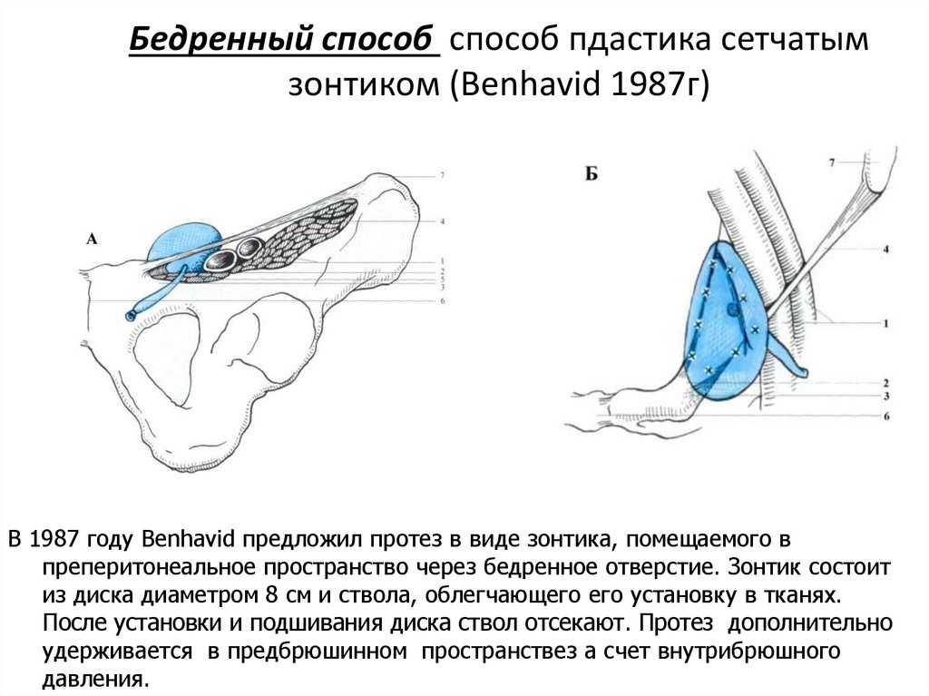 Бедренный способ. Холецистэктомия желчного пузыря лапароскопическая. Лапароскопическая холецистэктомия разрезы. Лапароскопическая хирургия желчный пузырь. Повреждение акромиально-ключичного сочленения рентген.