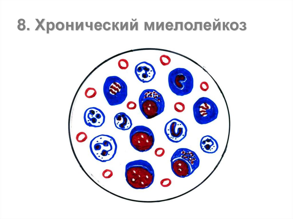 Хронический миелолейкоз. Лейкоциты при хроническом миелолейкозе. Эритроциты при хронический миелолейкоз. Хронический миелолейкоз рисунок. Хронический миелолейкоз 25%.