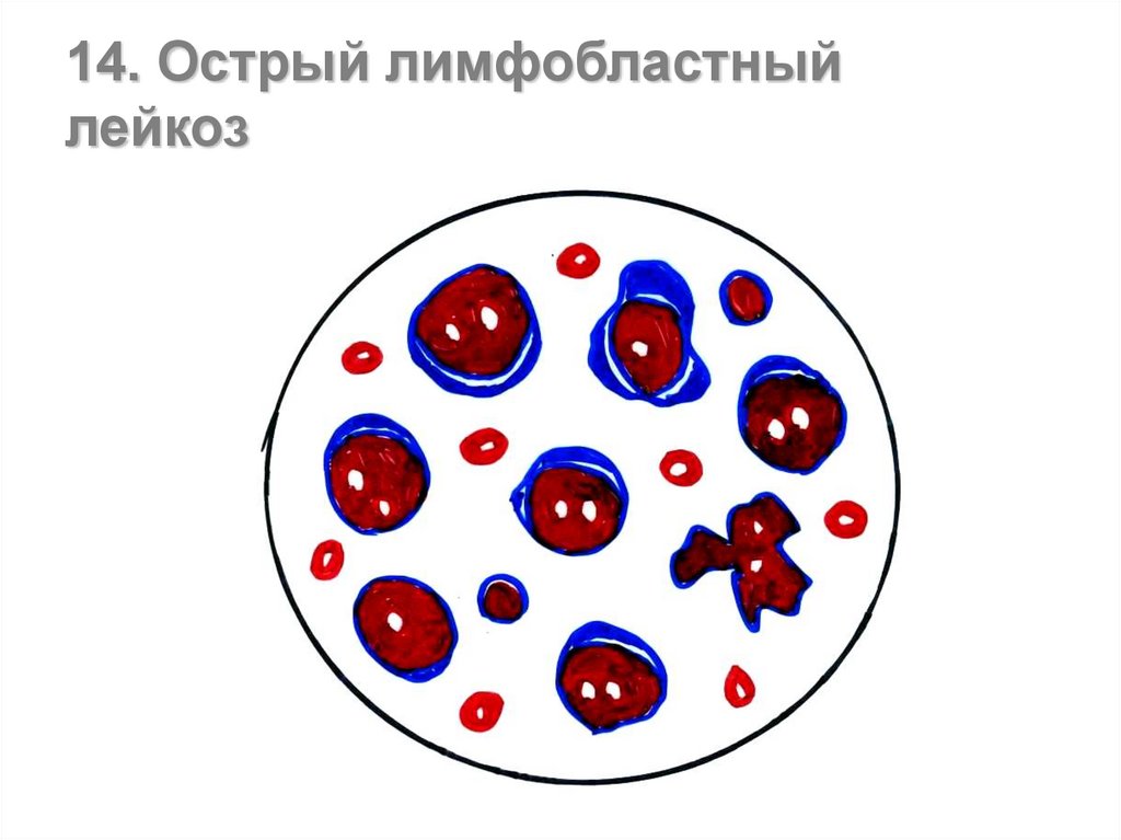 При хроническом моноцитарном лейкозе в картине крови характерен тест