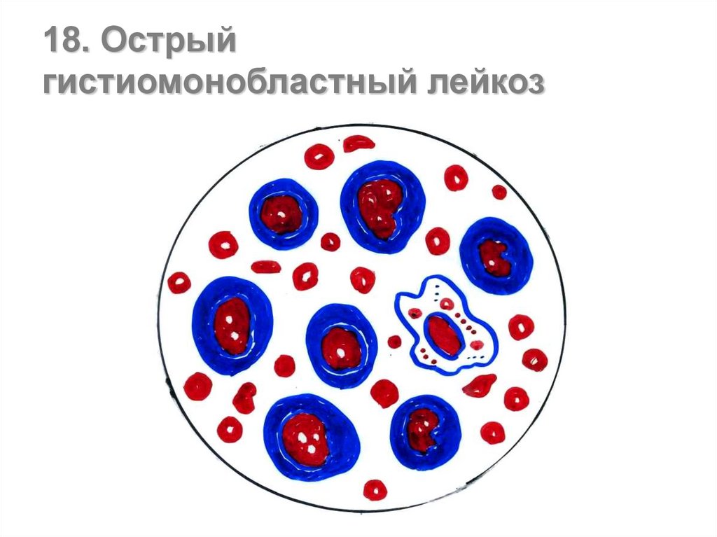 Недифференцированный лейкоз. Острый недифференцированный лейкоз. Недифференцированный лейкоз картина крови. Острый лейкоз картина крови. Острый монобластный лейкоз.