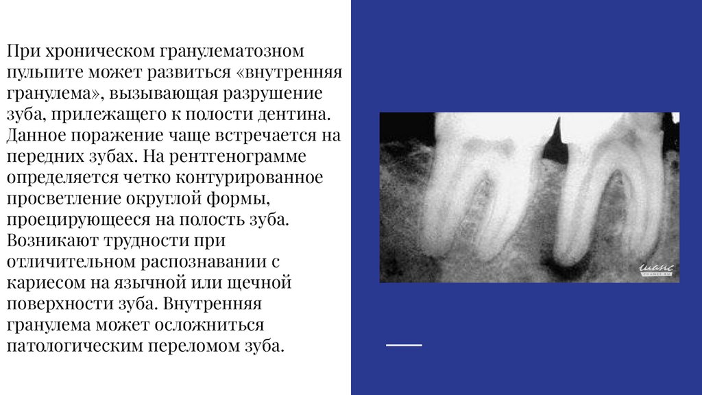 Рентгенологическая картина пульпитов - презентация онлайн