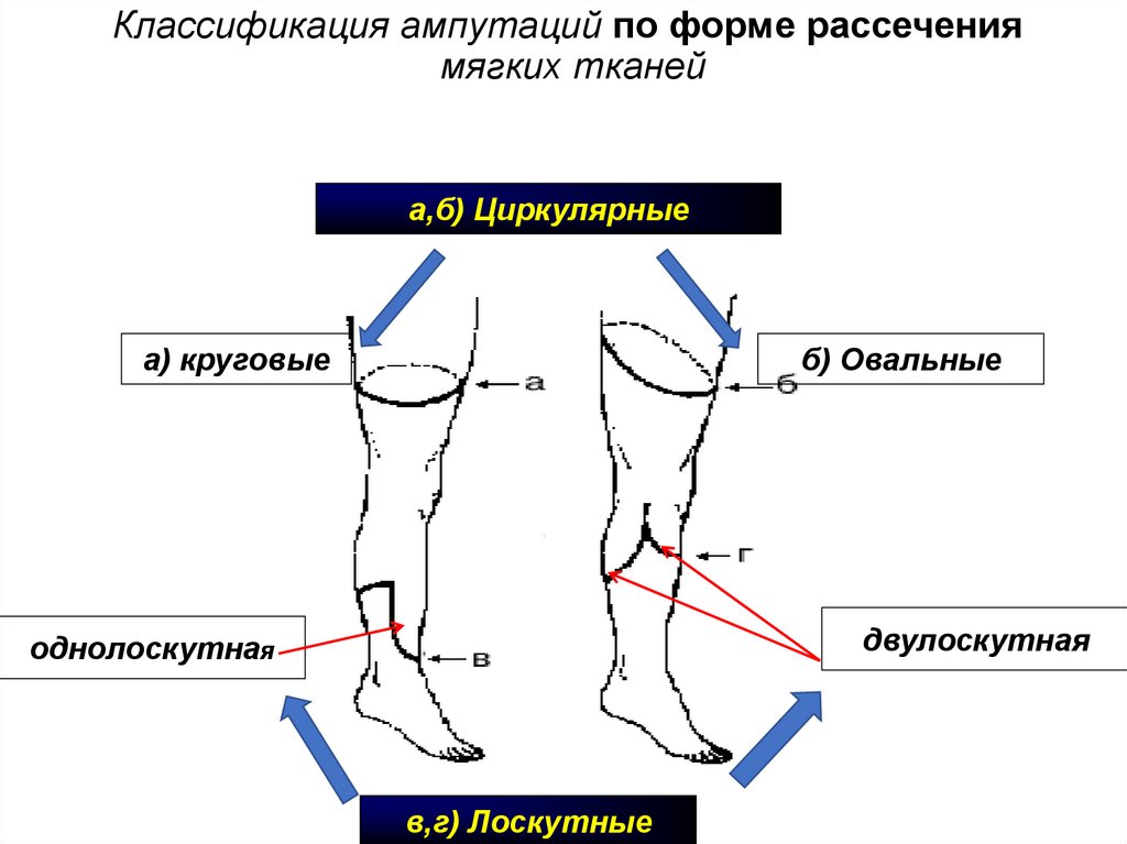 Классификация ампутаций