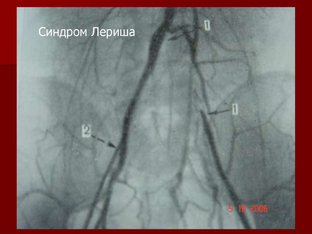 Окклюзия подвздошной артерии. Синдром Лериша ангиограмма. Синдром Лериша ангиография. Тромбоз бифуркации брюшной аорты (синдром Лериша). Синдром поражения бифуркации аорты.