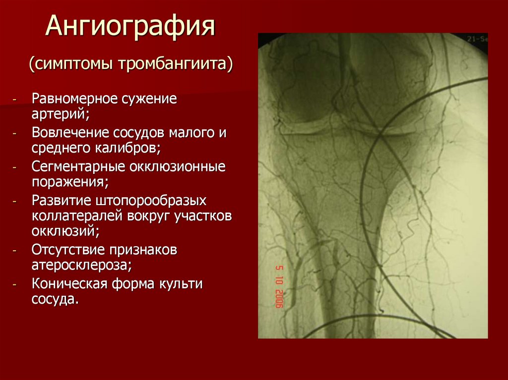 Артерий атеросклероз латынь. Атеросклероз артерий нижних конечностей ангиография. Болезнь Бюргера ангиография. Ангиография периферических артерий. Ангиографические симптомы.