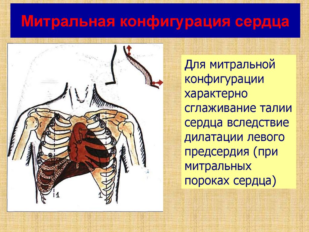 Аортальная конфигурация сердца схема