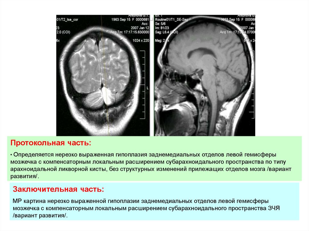 Гипоплазия правой головного мозга. Мрт головного мозга расширение субарахноидального пространства. Гипоплазия червя мозжечка кт. Локальное расширение субарахноидального пространства мрт. Арахноидальная киста лобной доли.