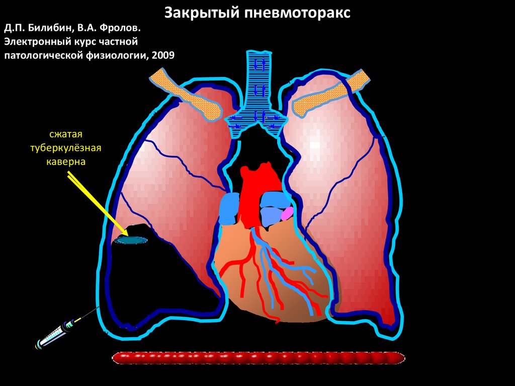 Пневмо- и гемоторакс: клиника, диагностика, неотложная помощь. Лекция ...