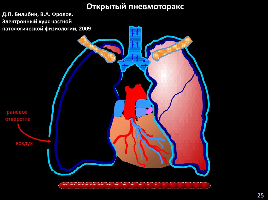 Пневмо- и гемоторакс: клиника, диагностика, неотложная помощь. Лекция ...