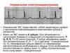 Нормальная электрокардиограмма