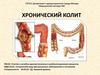 Хронический колит