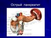 Острый панкреатит