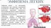 Эмфизема легких